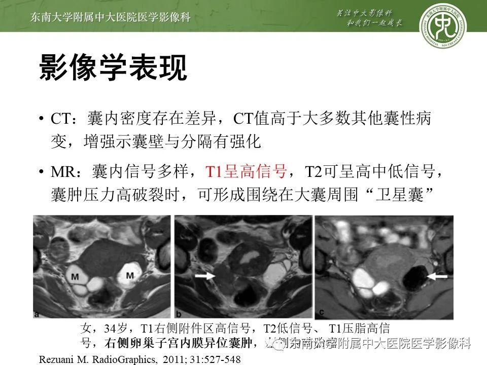 影像PPT - 【PPT】输卵管积脓-15