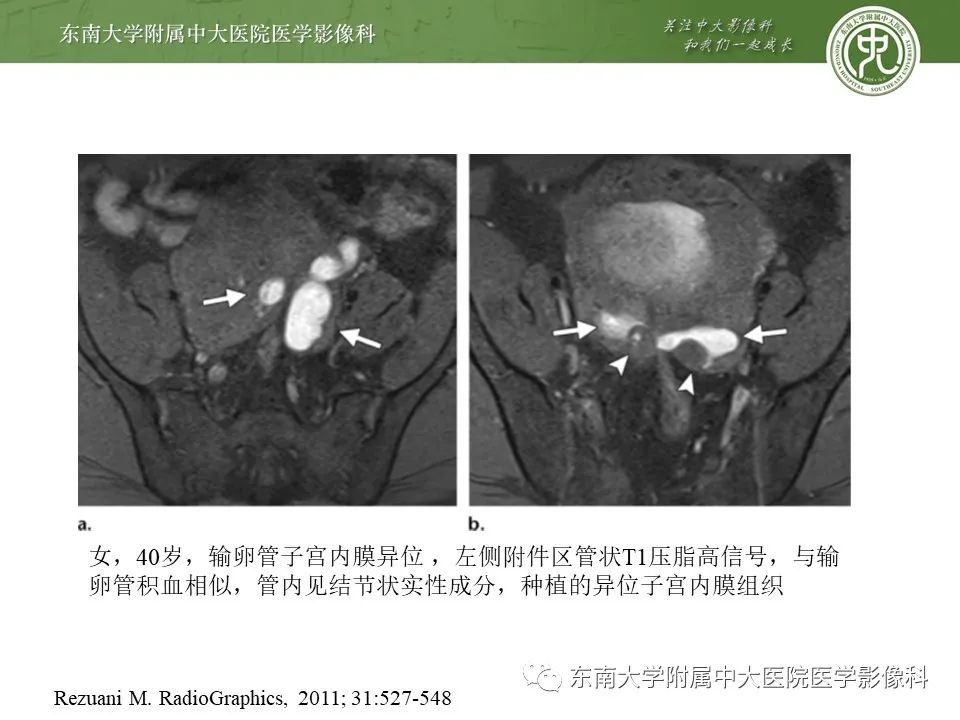 影像PPT - 【PPT】输卵管积脓-16