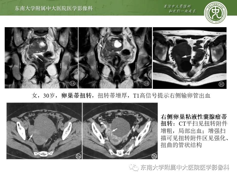 影像PPT - 【PPT】输卵管积脓-19
