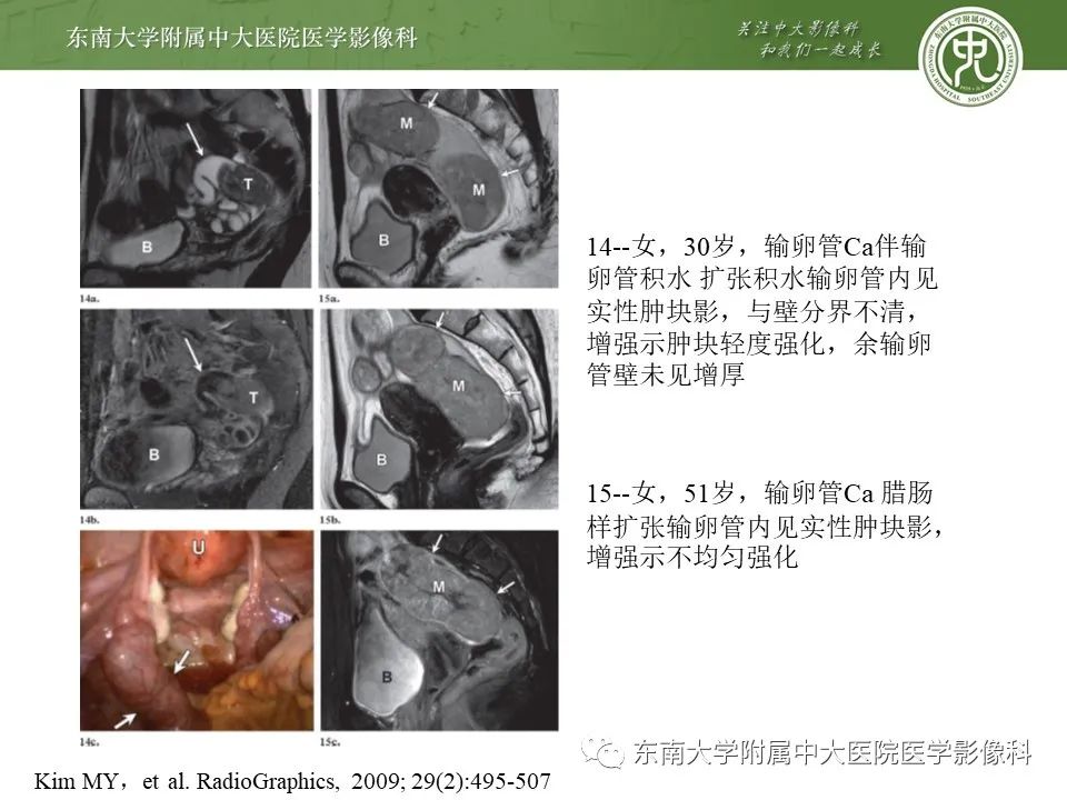 影像PPT - 【PPT】输卵管积脓-21