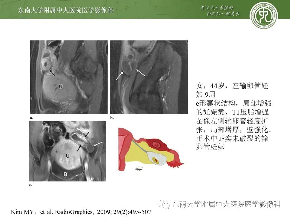 影像PPT - 【PPT】输卵管积脓-23