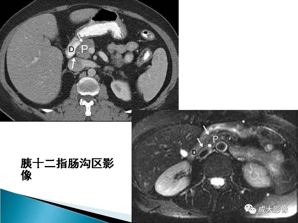 影像PPT - 【PPT】沟槽区胰腺炎的影像表现-3