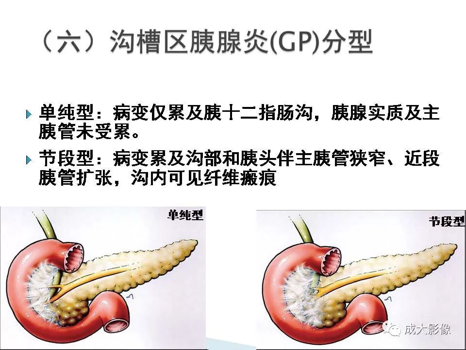 影像PPT - 【PPT】沟槽区胰腺炎的影像表现-10