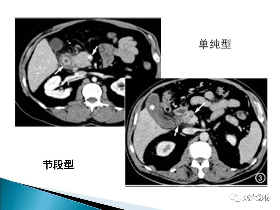 影像PPT - 【PPT】沟槽区胰腺炎的影像表现-13