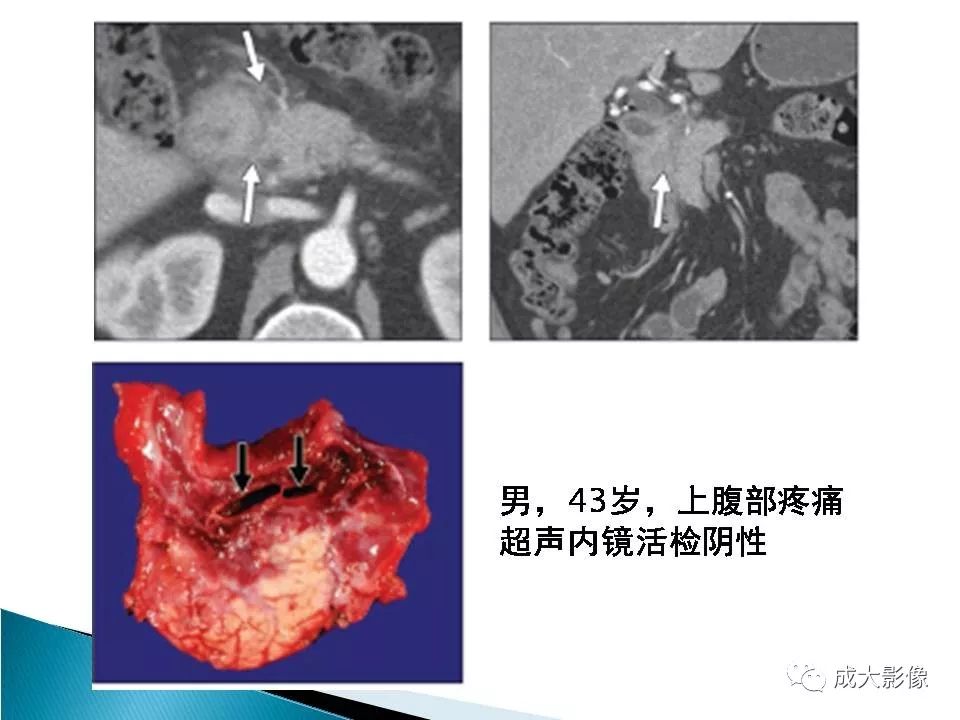影像PPT - 【PPT】沟槽区胰腺炎的影像表现-14