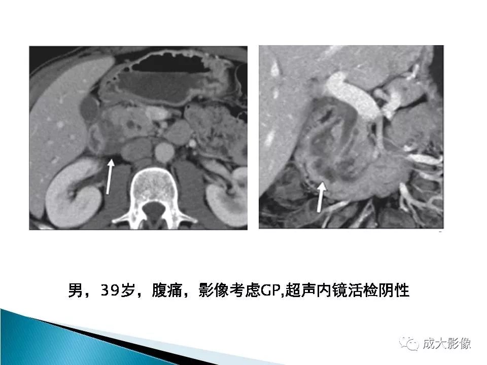 影像PPT - 【PPT】沟槽区胰腺炎的影像表现-15