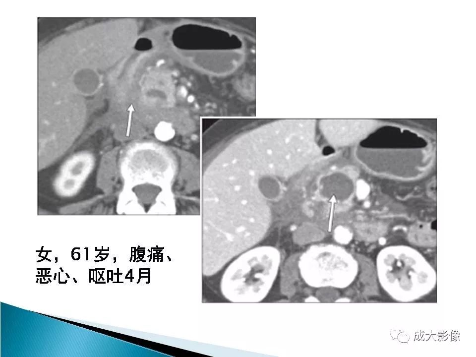 影像PPT - 【PPT】沟槽区胰腺炎的影像表现-16