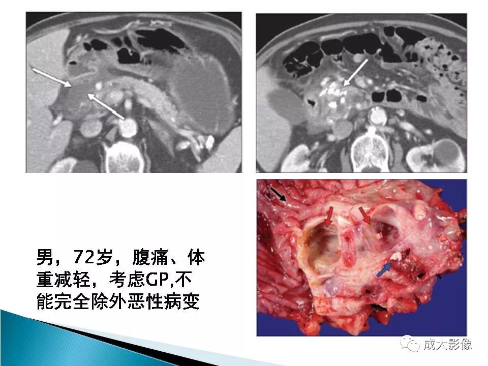 影像PPT - 【PPT】沟槽区胰腺炎的影像表现-17