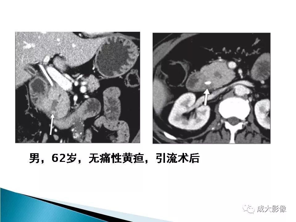 影像PPT - 【PPT】沟槽区胰腺炎的影像表现-18