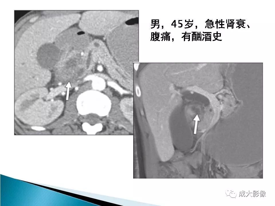 影像PPT - 【PPT】沟槽区胰腺炎的影像表现-19