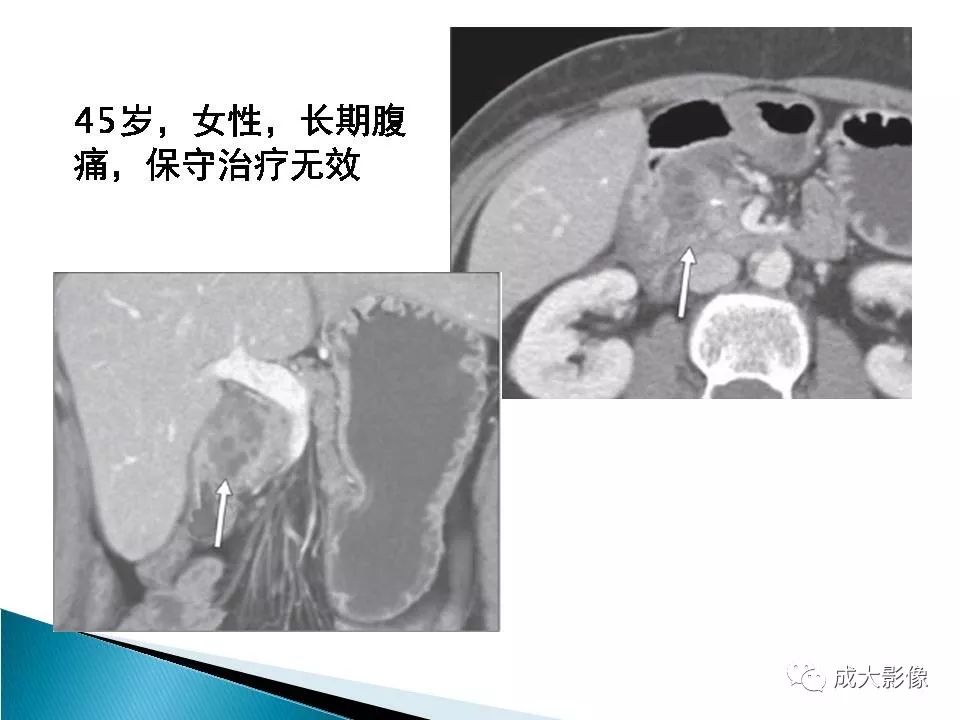 影像PPT - 【PPT】沟槽区胰腺炎的影像表现-20