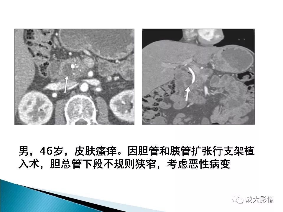 影像PPT - 【PPT】沟槽区胰腺炎的影像表现-21