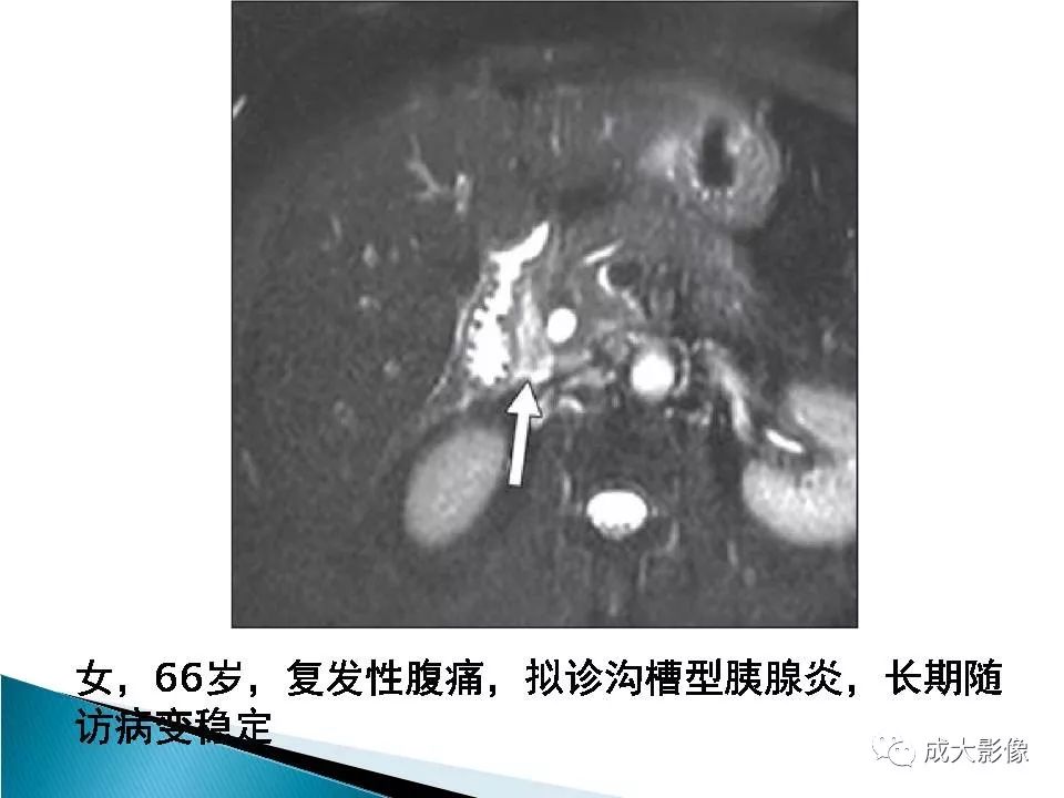 影像PPT - 【PPT】沟槽区胰腺炎的影像表现-24