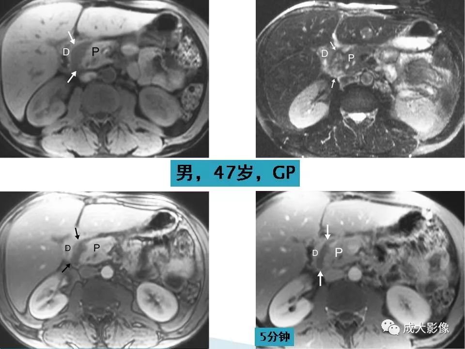 影像PPT - 【PPT】沟槽区胰腺炎的影像表现-26
