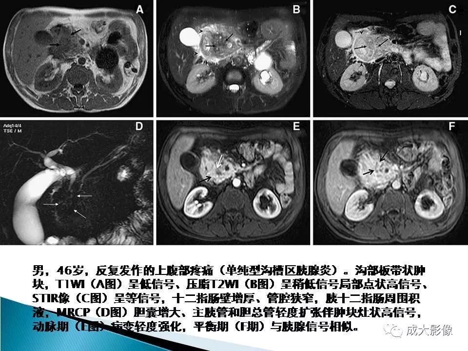 影像PPT - 【PPT】沟槽区胰腺炎的影像表现-27