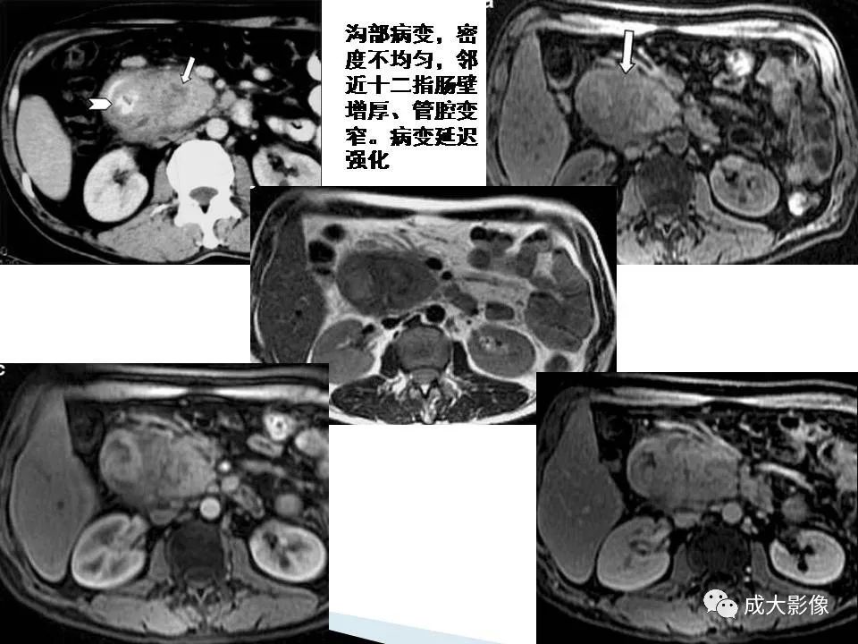 影像PPT - 【PPT】沟槽区胰腺炎的影像表现-28