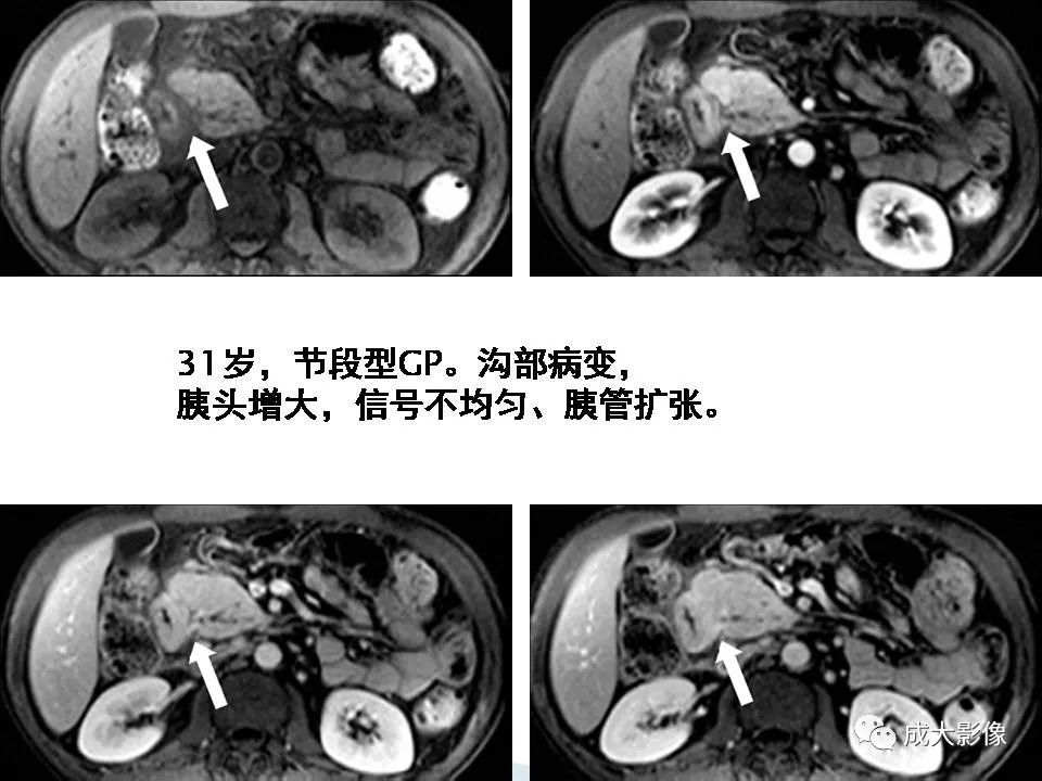 影像PPT - 【PPT】沟槽区胰腺炎的影像表现-30