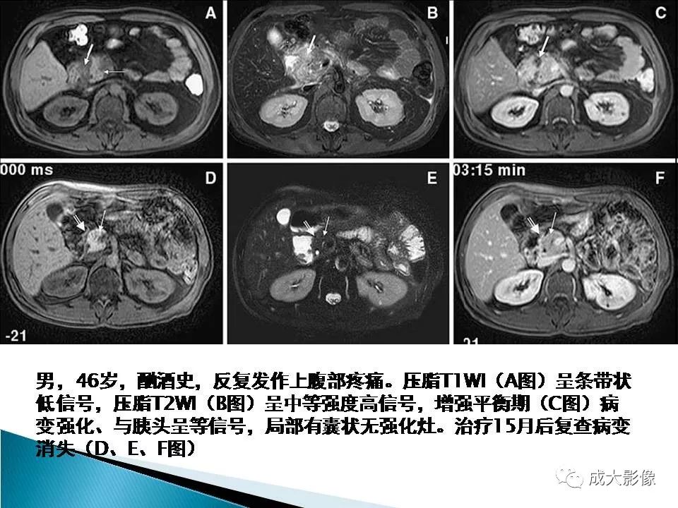 影像PPT - 【PPT】沟槽区胰腺炎的影像表现-31