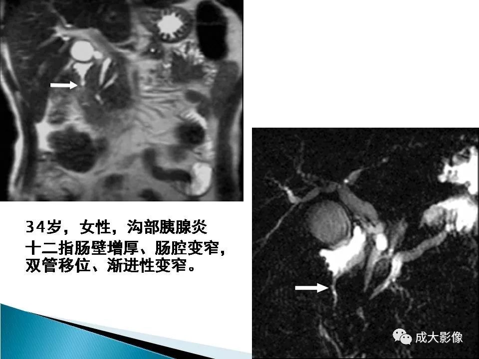 影像PPT - 【PPT】沟槽区胰腺炎的影像表现-33