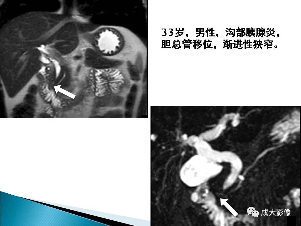 影像PPT - 【PPT】沟槽区胰腺炎的影像表现-34