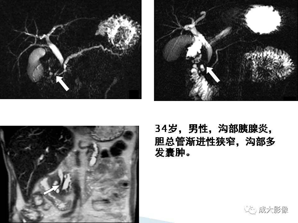 影像PPT - 【PPT】沟槽区胰腺炎的影像表现-35