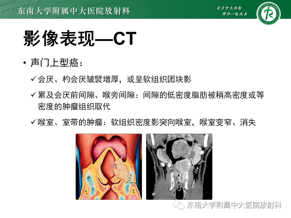 影像PPT - 【PPT】喉癌-21