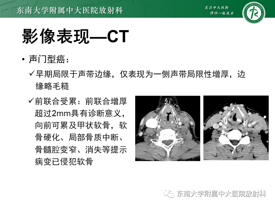 影像PPT - 【PPT】喉癌-22