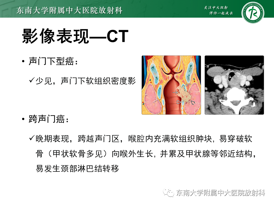 影像PPT - 【PPT】喉癌-23