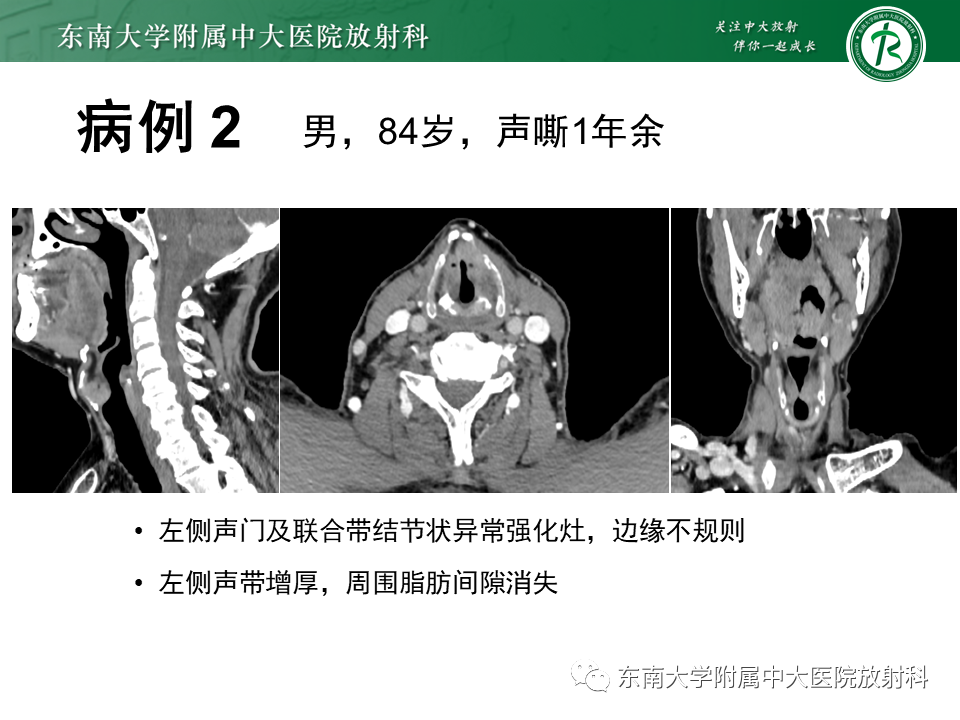 影像PPT - 【PPT】喉癌-25