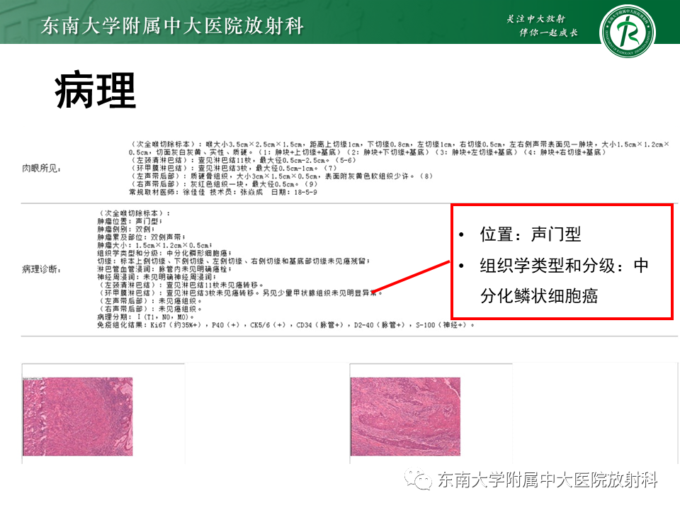 影像PPT - 【PPT】喉癌-26