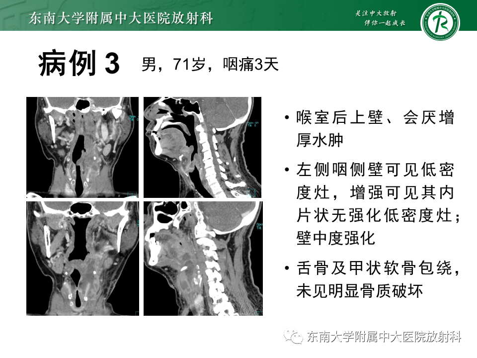 影像PPT - 【PPT】喉癌-28