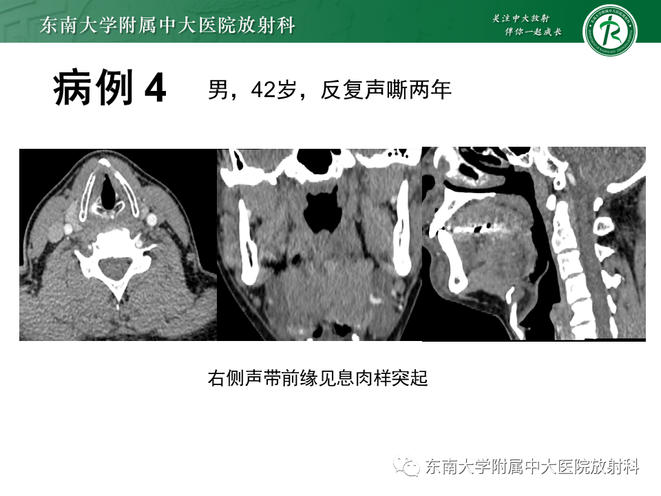 影像PPT - 【PPT】喉癌-30