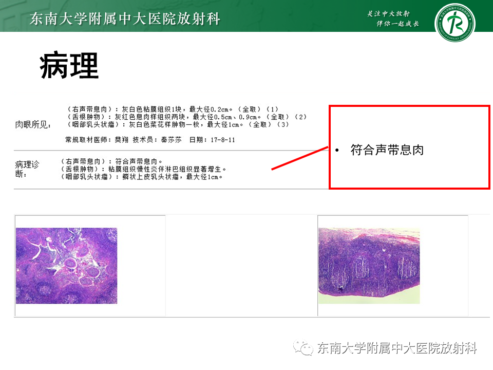 影像PPT - 【PPT】喉癌-31