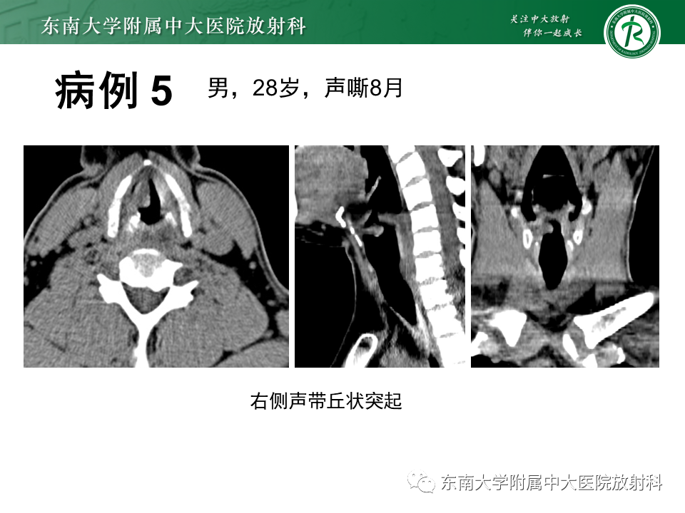 影像PPT - 【PPT】喉癌-33