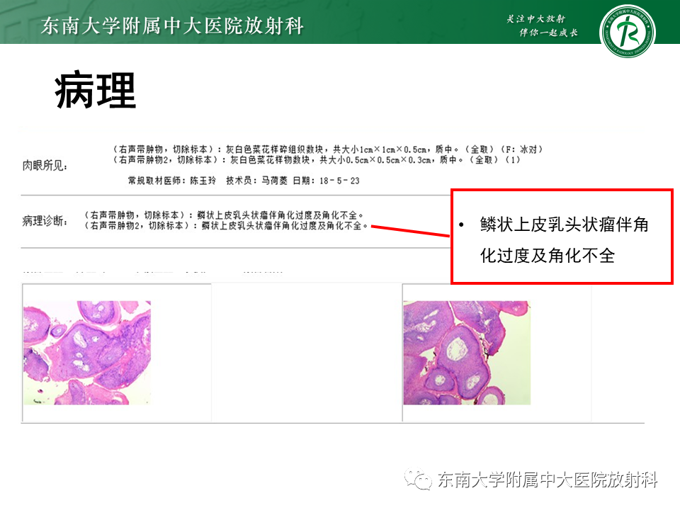 影像PPT - 【PPT】喉癌-34