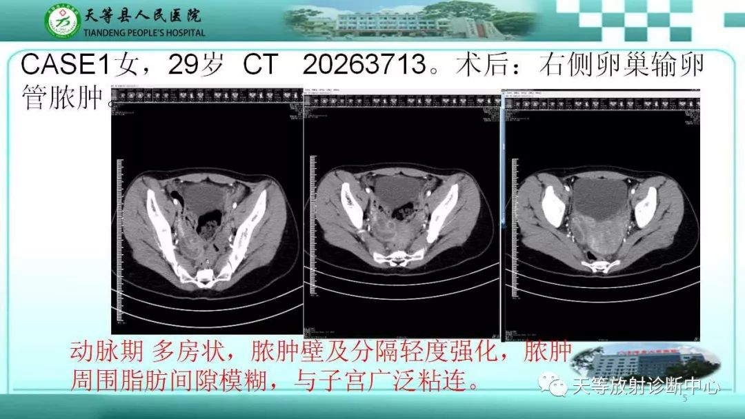 影像PPT - 【PPT】输卵管卵巢脓肿CT、MRI诊断及鉴别诊断-5 影像PPT - 【PPT】输卵管卵巢脓肿CT、MRI诊断及鉴别诊断-5