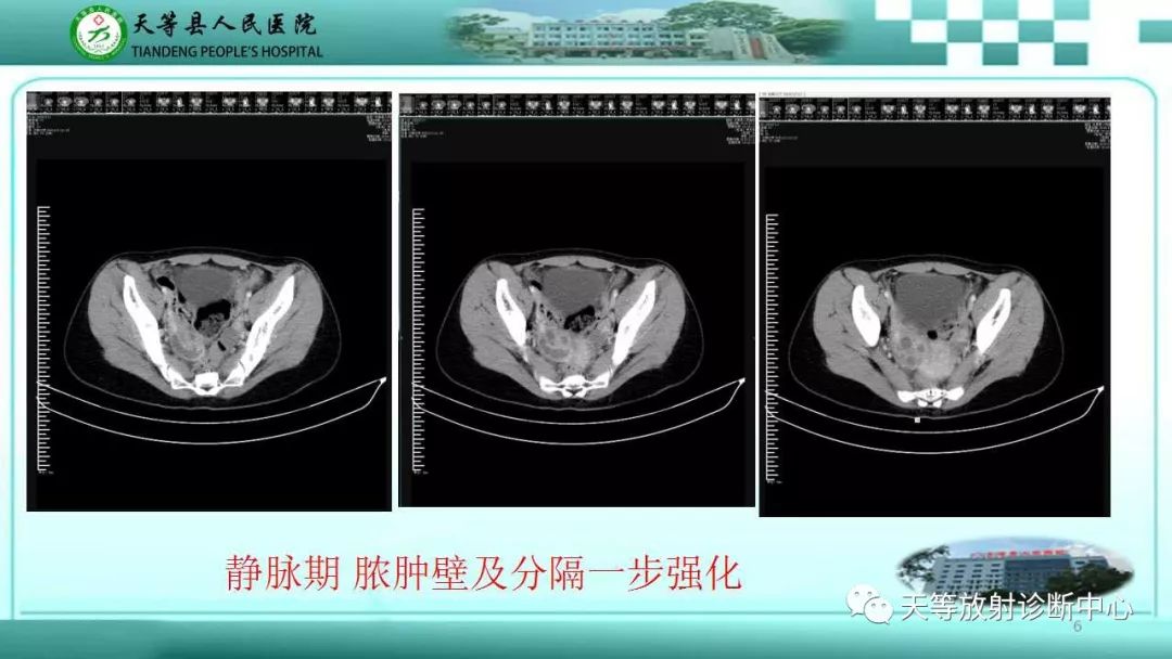 影像PPT - 【PPT】输卵管卵巢脓肿CT、MRI诊断及鉴别诊断-6 影像PPT - 【PPT】输卵管卵巢脓肿CT、MRI诊断及鉴别诊断-6