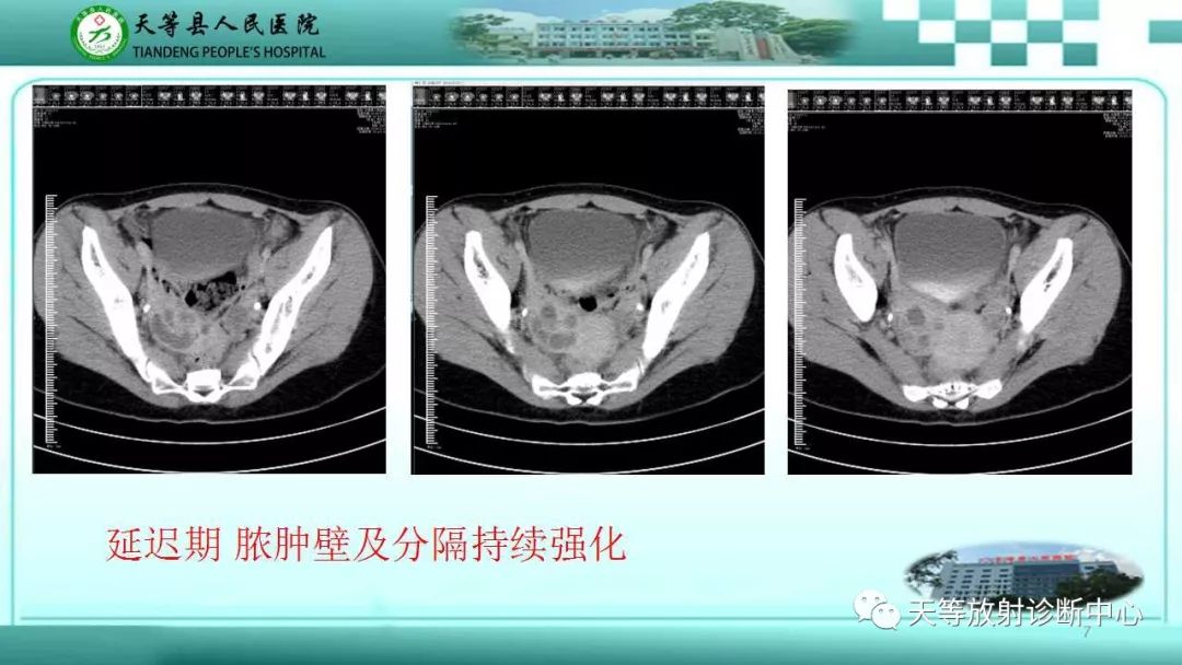 影像PPT - 【PPT】输卵管卵巢脓肿CT、MRI诊断及鉴别诊断-7 影像PPT - 【PPT】输卵管卵巢脓肿CT、MRI诊断及鉴别诊断-7