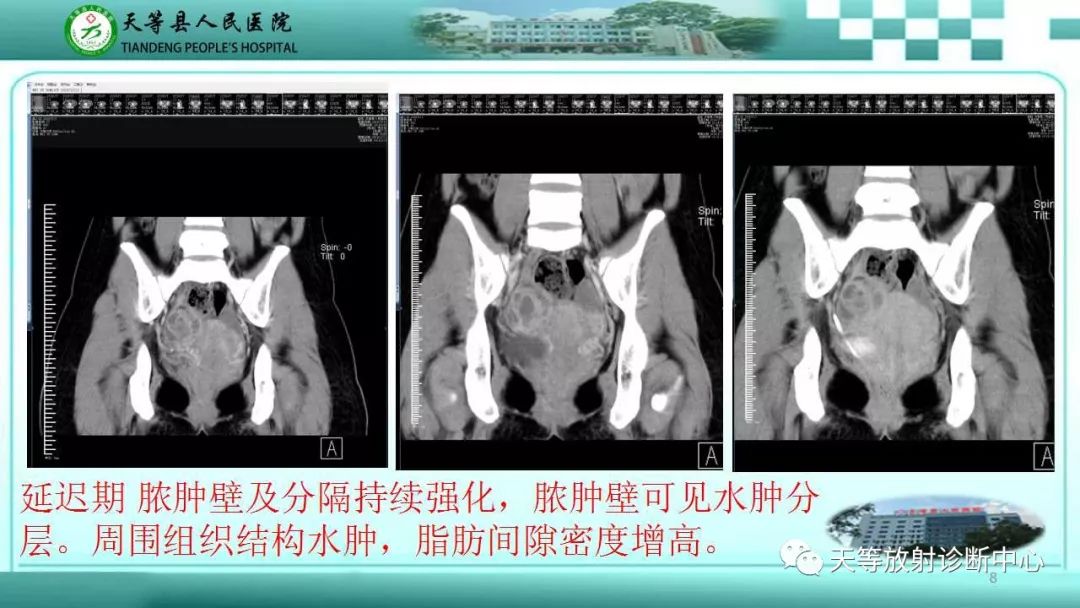 影像PPT - 【PPT】输卵管卵巢脓肿CT、MRI诊断及鉴别诊断-8 影像PPT - 【PPT】输卵管卵巢脓肿CT、MRI诊断及鉴别诊断-8