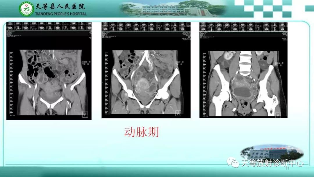 影像PPT - 【PPT】输卵管卵巢脓肿CT、MRI诊断及鉴别诊断-11 影像PPT - 【PPT】输卵管卵巢脓肿CT、MRI诊断及鉴别诊断-11