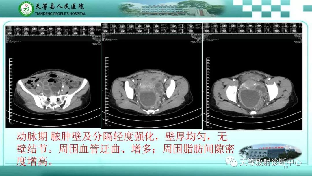 影像PPT - 【PPT】输卵管卵巢脓肿CT、MRI诊断及鉴别诊断-10 影像PPT - 【PPT】输卵管卵巢脓肿CT、MRI诊断及鉴别诊断-10
