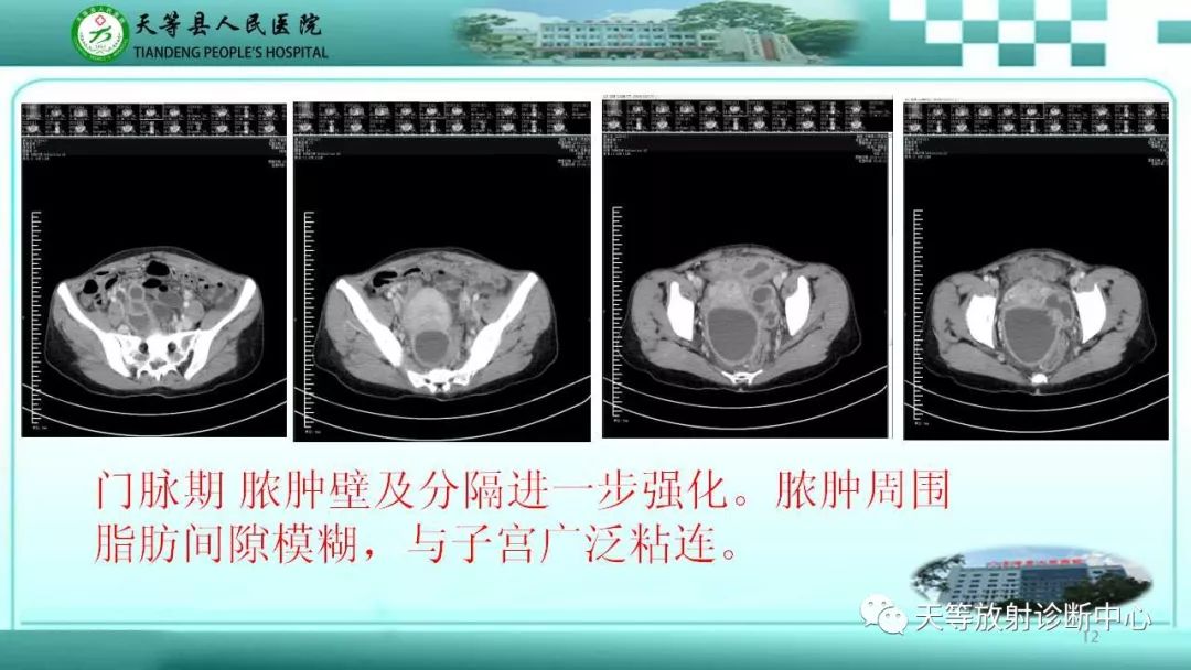 影像PPT - 【PPT】输卵管卵巢脓肿CT、MRI诊断及鉴别诊断-12 影像PPT - 【PPT】输卵管卵巢脓肿CT、MRI诊断及鉴别诊断-12