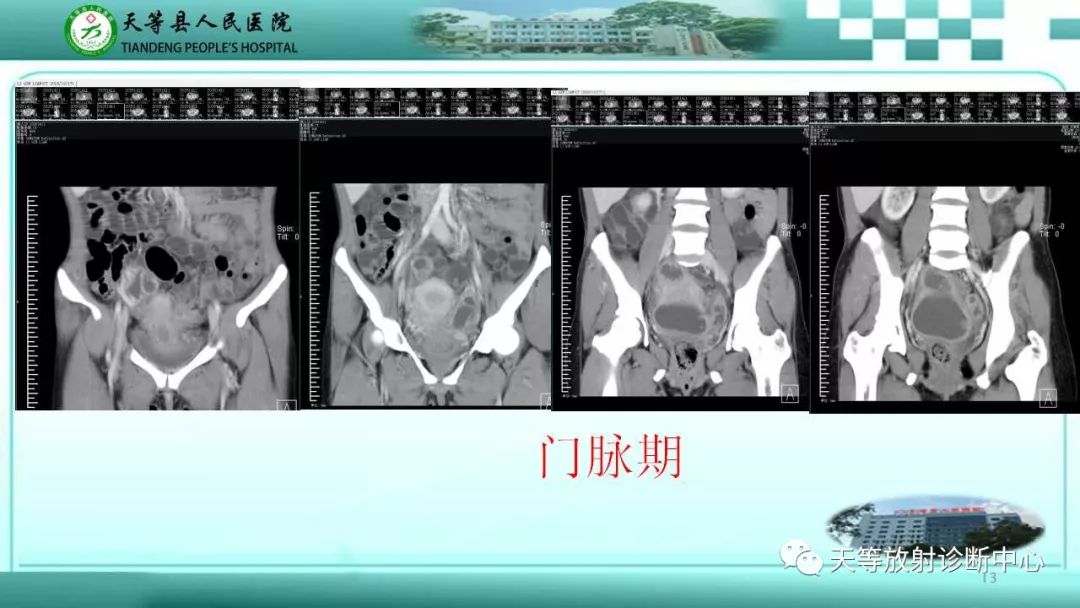 影像PPT - 【PPT】输卵管卵巢脓肿CT、MRI诊断及鉴别诊断-13 影像PPT - 【PPT】输卵管卵巢脓肿CT、MRI诊断及鉴别诊断-13