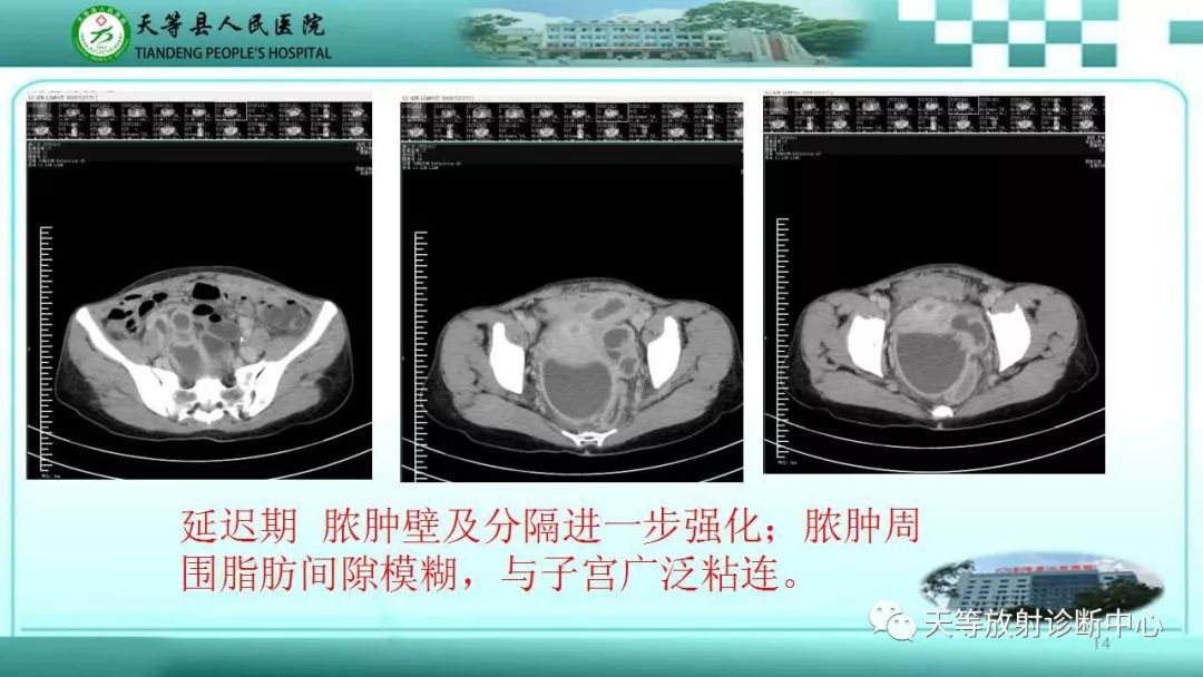 影像PPT - 【PPT】输卵管卵巢脓肿CT、MRI诊断及鉴别诊断-14 影像PPT - 【PPT】输卵管卵巢脓肿CT、MRI诊断及鉴别诊断-14