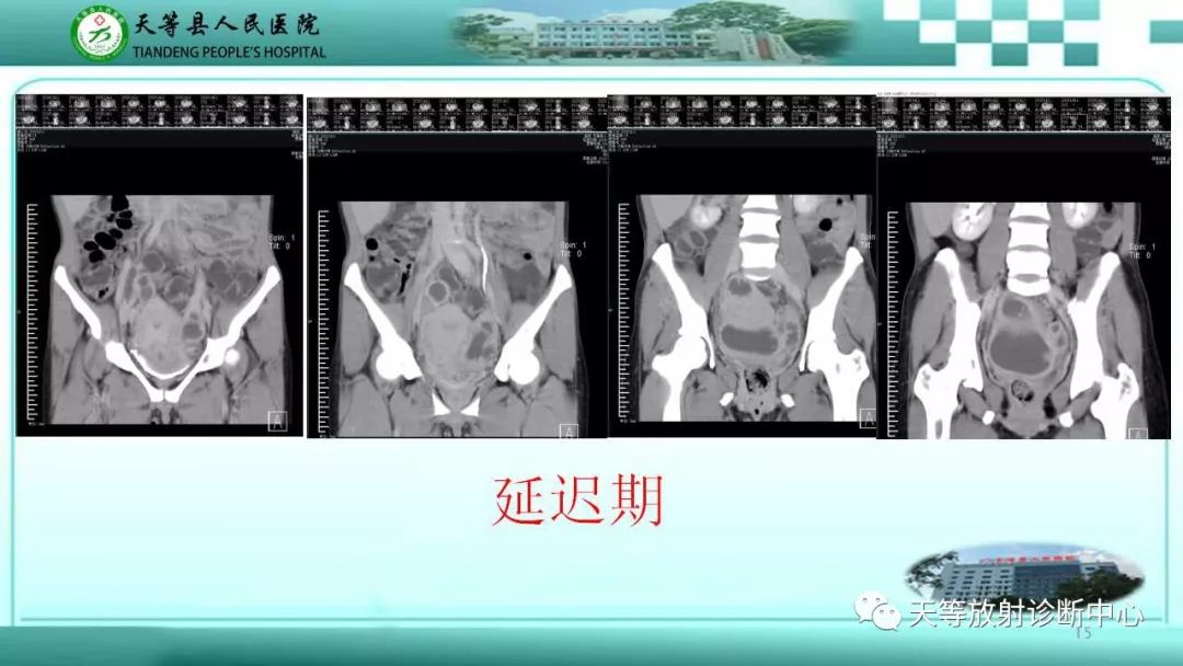 影像PPT - 【PPT】输卵管卵巢脓肿CT、MRI诊断及鉴别诊断-15 影像PPT - 【PPT】输卵管卵巢脓肿CT、MRI诊断及鉴别诊断-15