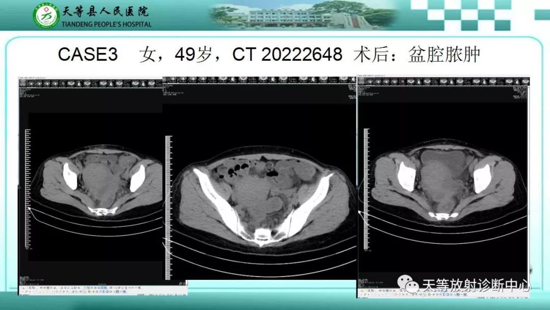 影像PPT - 【PPT】输卵管卵巢脓肿CT、MRI诊断及鉴别诊断-16 影像PPT - 【PPT】输卵管卵巢脓肿CT、MRI诊断及鉴别诊断-16