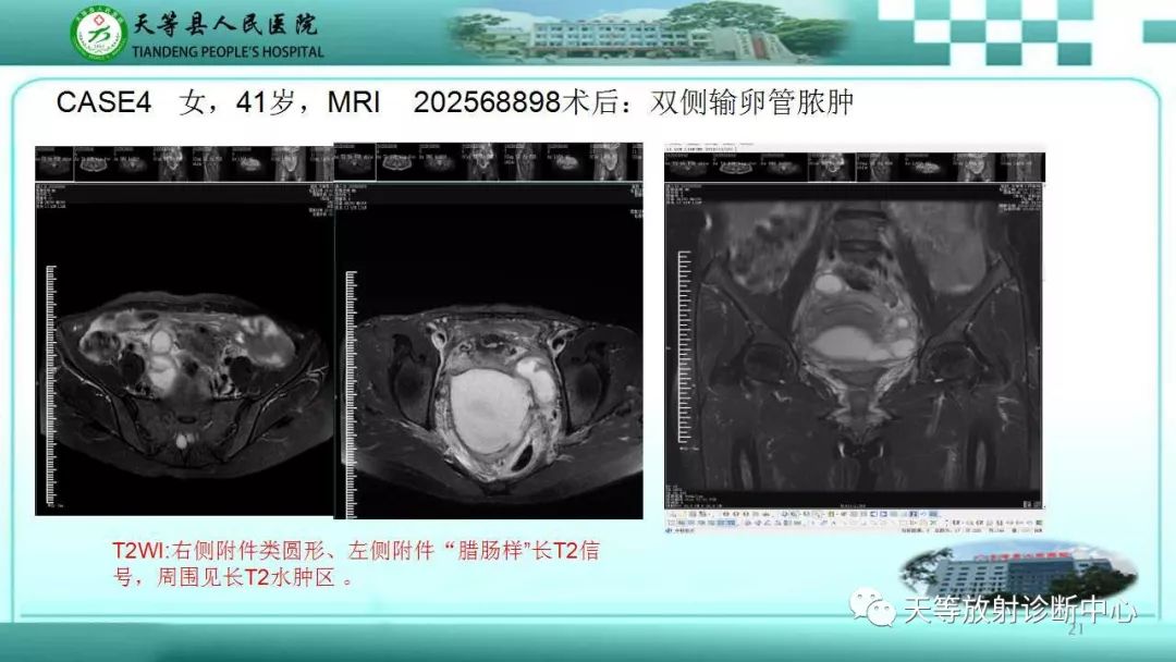 影像PPT - 【PPT】输卵管卵巢脓肿CT、MRI诊断及鉴别诊断-21 影像PPT - 【PPT】输卵管卵巢脓肿CT、MRI诊断及鉴别诊断-21