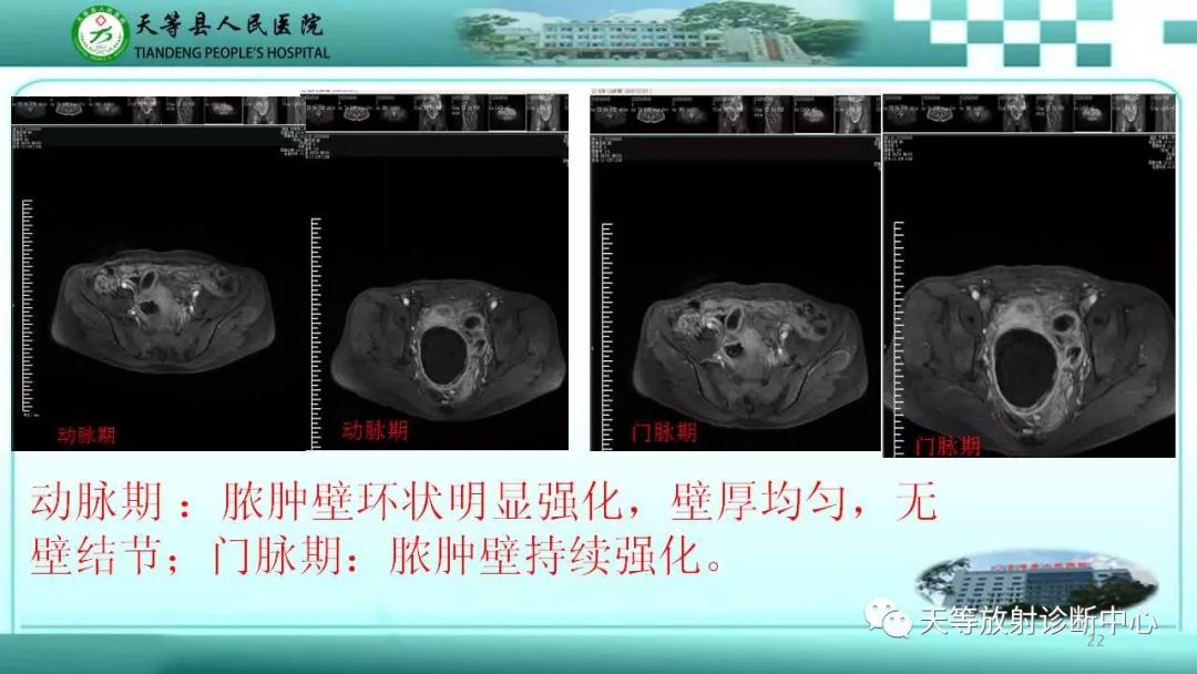 影像PPT - 【PPT】输卵管卵巢脓肿CT、MRI诊断及鉴别诊断-22 影像PPT - 【PPT】输卵管卵巢脓肿CT、MRI诊断及鉴别诊断-22