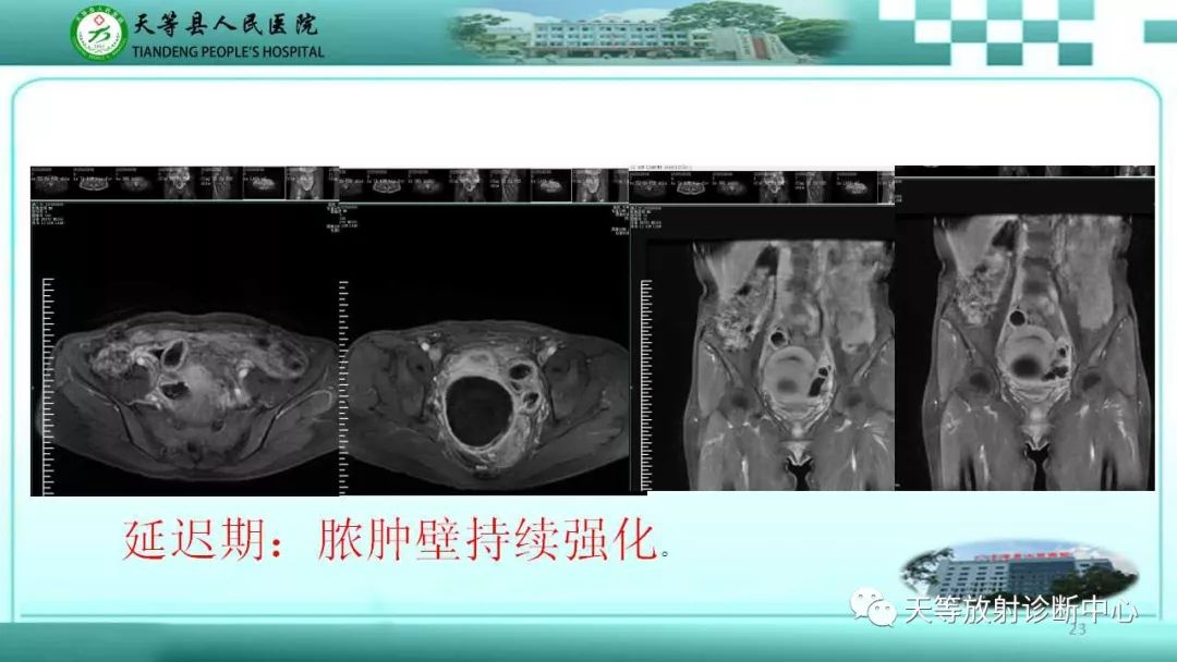 影像PPT - 【PPT】输卵管卵巢脓肿CT、MRI诊断及鉴别诊断-23 影像PPT - 【PPT】输卵管卵巢脓肿CT、MRI诊断及鉴别诊断-23