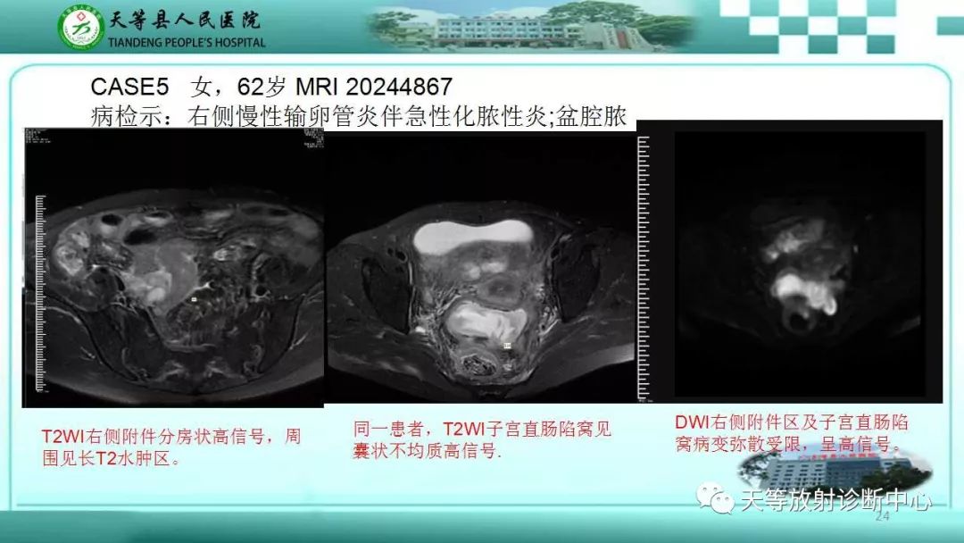 影像PPT - 【PPT】输卵管卵巢脓肿CT、MRI诊断及鉴别诊断-24 影像PPT - 【PPT】输卵管卵巢脓肿CT、MRI诊断及鉴别诊断-24
